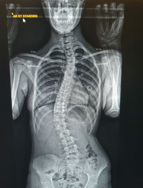 Midge spine